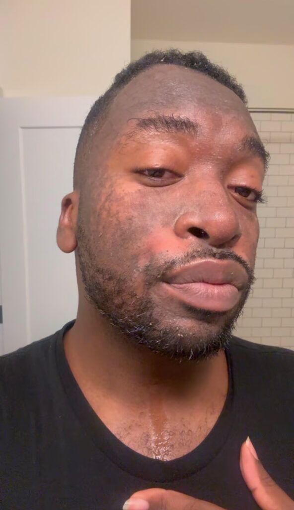 Après le facial au laser avec un peu de pelage
